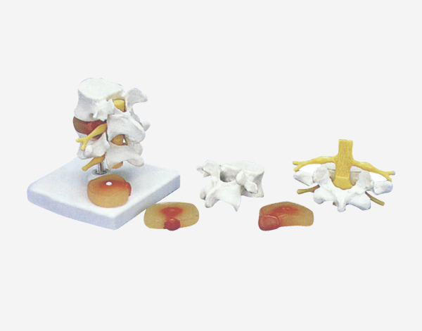  Lumbar Set With Disease Discs Model